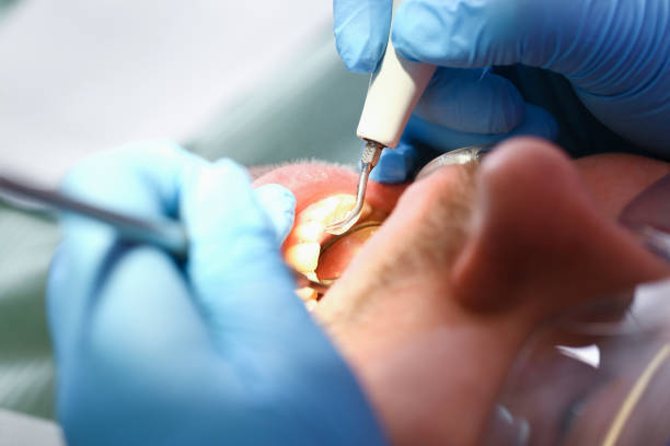 Best Dentist for Tooth Abscess  in Wellsville, OH