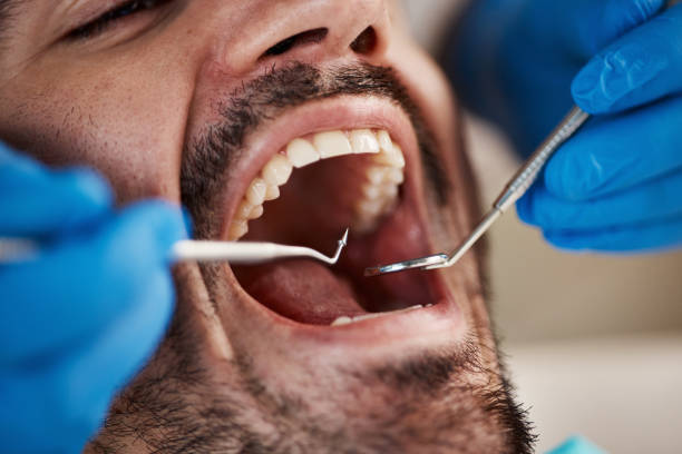 Best Chipped Tooth Repair Near Me  in Wellsville, OH