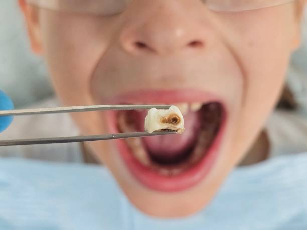 Best Emergency Dental Filling Replacement  in Wellsville, OH